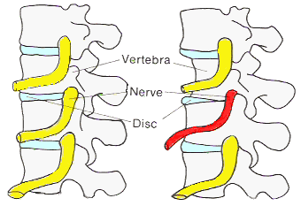 Pinched Nerve in Neck: Causes, Symptoms, and Treatments